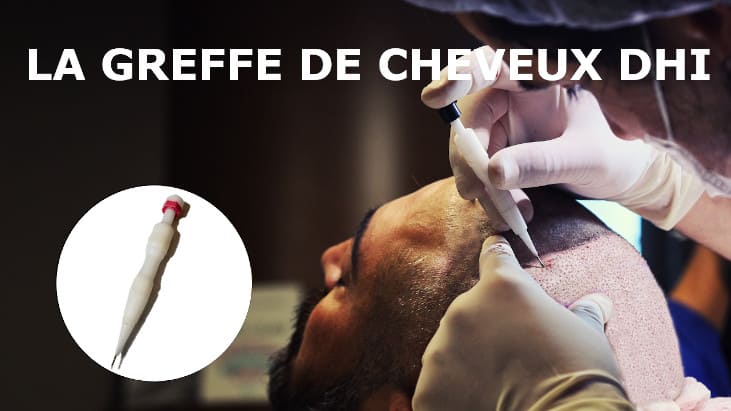 Greffe de cheveux dhi enfin abordable en turquie